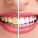 cara memutihkan gigi kuning